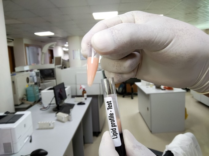 Felborult a lipidprofilja? Ezzel a 8 egyszerű lépéssel fellélegezhetnek az erei című cikk nyitóképe