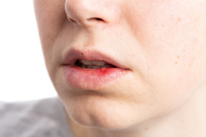 A szájon számos ok miatt megjelenhet egy-egy csomó, dudor vagy seb, de amíg egy pattanást vagy herpeszt könnyen beazonosítunk, néhány esetben fontos, hogy bőrgyógyász lássa az elváltozást!