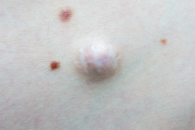 Mi az az atheroma, és mikor kell műteni? című cikk nyitóképe