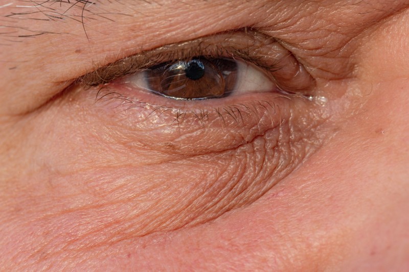 Csüngő szemhéj: ilyen az, amikor belső cisztát jelez