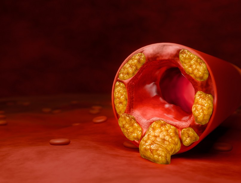 magas koleszterin ellen gyógyszer módszer mozgás