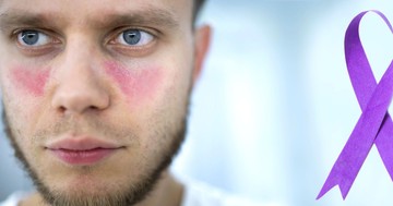 A lupus első jelei: ezeket a tüneteket sokan hónapokig figyelmen kívül hagyják