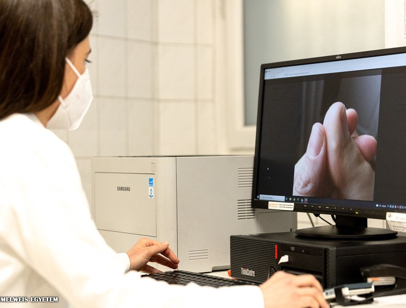 melanóma, bőrdaganat, bőrbetegség, Semmelweis Egyetem