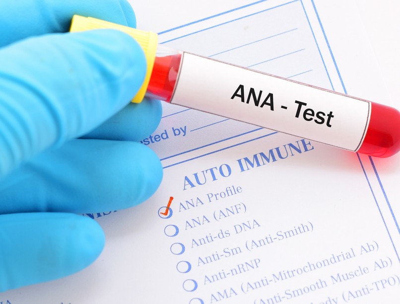 Mi az ANA teszt