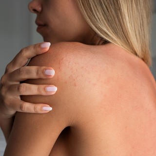 Ez a kellemetlen allergia az egész nyaralást tönkreteheti – amint jelentkezik árnyékba kell húzódni! című cikk nyitóképe