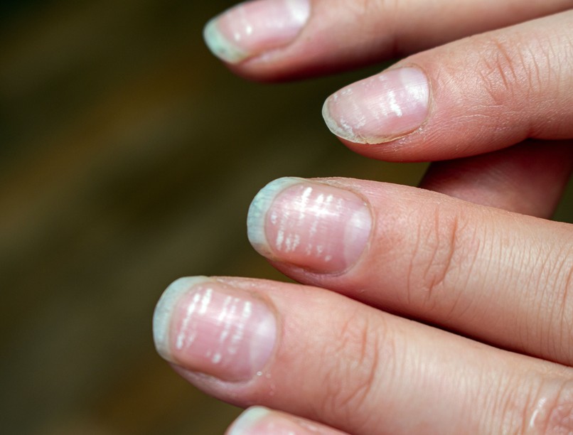 apró, fehér foltok pöttyök oka köröm májbetegség jele tünete