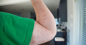  Reggelre tele lett csípésnyomokkal? Innen tudhatja, mi okozta 