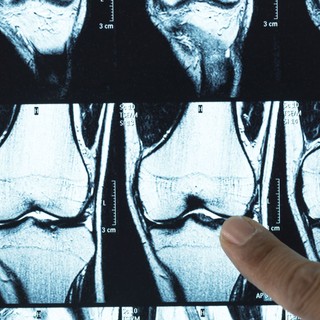 Felfedezték, miért pusztul el a porcszövet az osteoarthritisben, és hogyan lehet azt helyreállítani című cikk nyitóképe