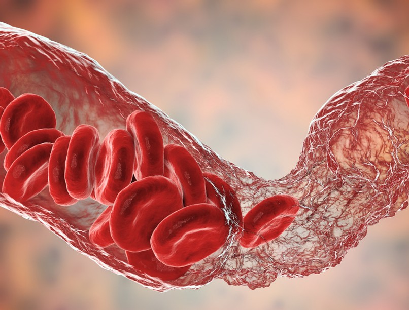 vérrög, trombózis, koronavírus, oltás, covid-19, astrazeneca, pfizer