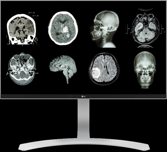 Magyarországra is megérkeztek az LG egészségügyi monitorai című cikk nyitóképe