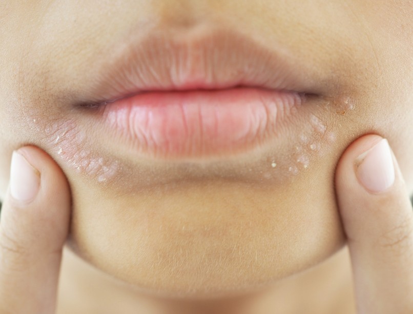 allergia ételallergia allergiás kiütések