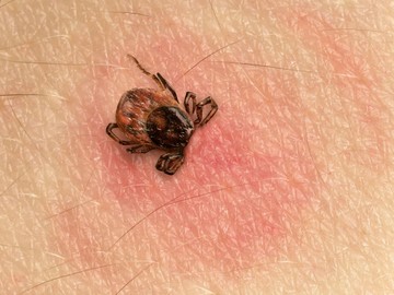 A Lyme-kór kezelése után is jelentkeznek tünetek? Ez lehet az oka!