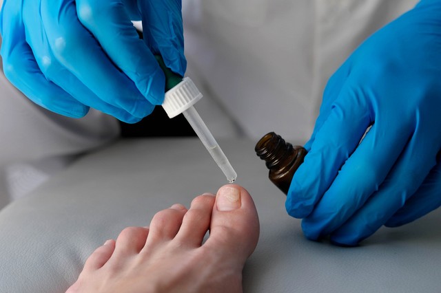 Körömgomba ellen ezt a tanácsot fogadja meg a bőrgyógyásztól!