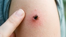 Meddig lehet a bőrében a kullancs, mielőtt megfertőzi? A 24 órás szabály nem mindig igaz című cikk nyitóképe