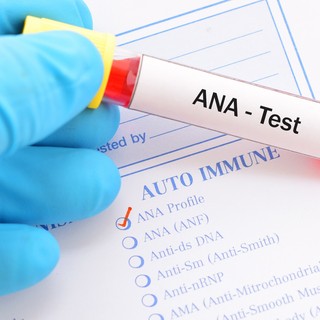 Mi az ANA teszt és mit mutat ki? című cikk nyitóképe
