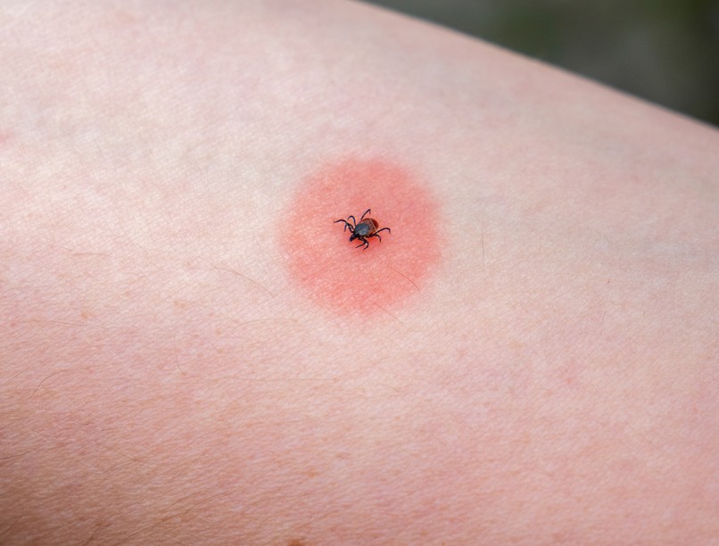 kullancs, kullancscsípés, lyme-kór, fsme