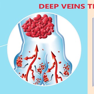 Mélyvénák gyulladása, elzáródása: tünetei, vizsgálata és kezelése című cikk nyitóképe