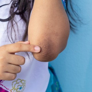 Ezek a tünetek cukorbetegséget is jelezhetnek, de a legtöbben nem is gondolnának rá című cikk nyitóképe