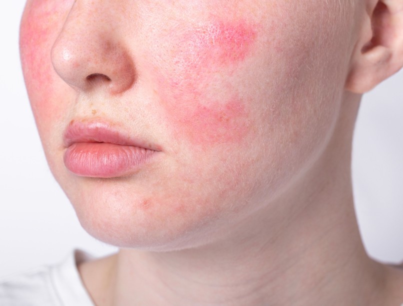 égő vörös arc oka rosacea klimax hormonzavar