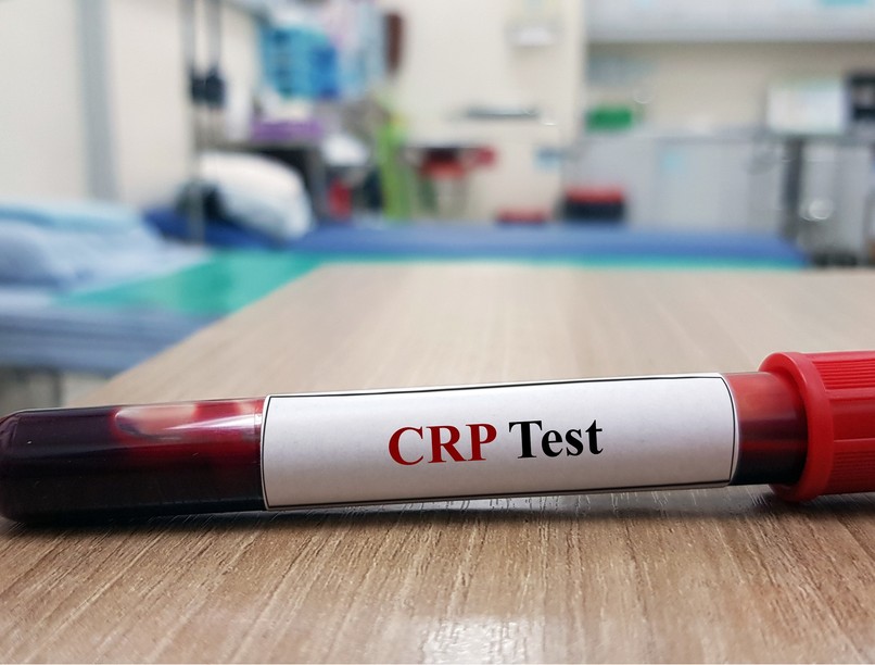 Mit jelent CRP érték laborlelet