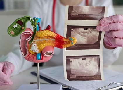 Új remény a hasnyálmirigyrák ellen: D-vitaminnal bontják le a daganat védőpajzsát című cikk nyitóképe
