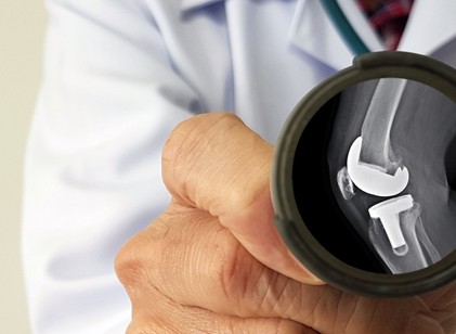 Mennyi ideig tart a felépülni csípő- és térdprotézis beültetés után? című cikk nyitóképe