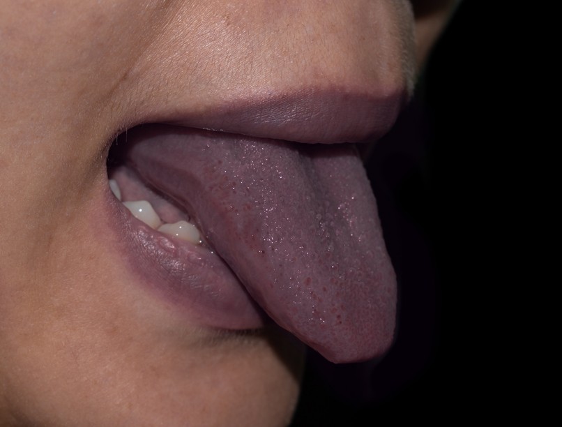 szederjesség cyanosis, kékes bőrszín tünet