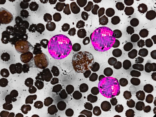 Trombocitózis, trombocitémia: tünetek, kivizsgálás és kezelési lehetőségek