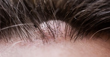  Rejtélyes dudor a bőrön: így szabaduljon meg a kásadaganattól 