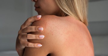 Ez a kellemetlen allergia az egész nyaralást tönkreteheti – amint jelentkezik árnyékba kell húzódni!
