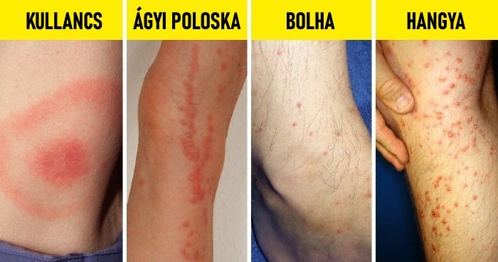 Poloska, hangya, bolha, pók, szúnyog: a leggyakoribb rovarcsípések nyomát mutatjuk meg képeken, hogy könnyen el tudja dönteni, mi csípte meg.