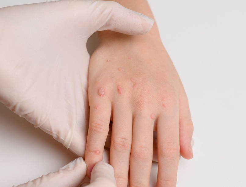 szemölcs gyerek kezelés otthon veszélyes