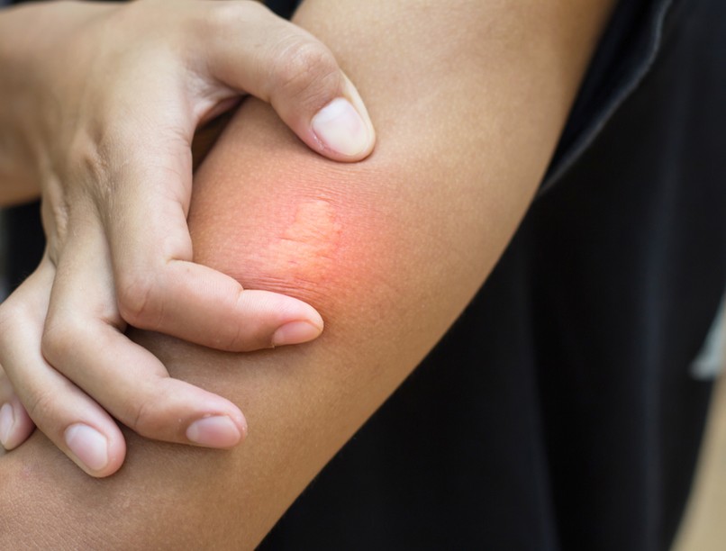 Csípések: bolhacsípés, hangyacsípés, poloskacsípés, szúnyogcsípés, kullancscsípés