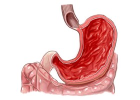 Operáció nélküli refluxműtét?