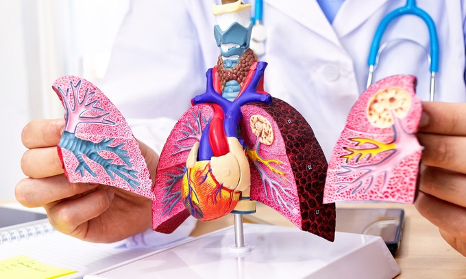 Mi a tüdőtranszplantáció (tüdő átültetés)? című cikk nyitóképe