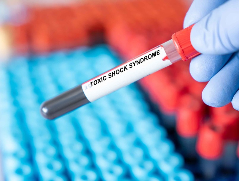Toxikus sokk szindróma tünet vizsgálat kezelés