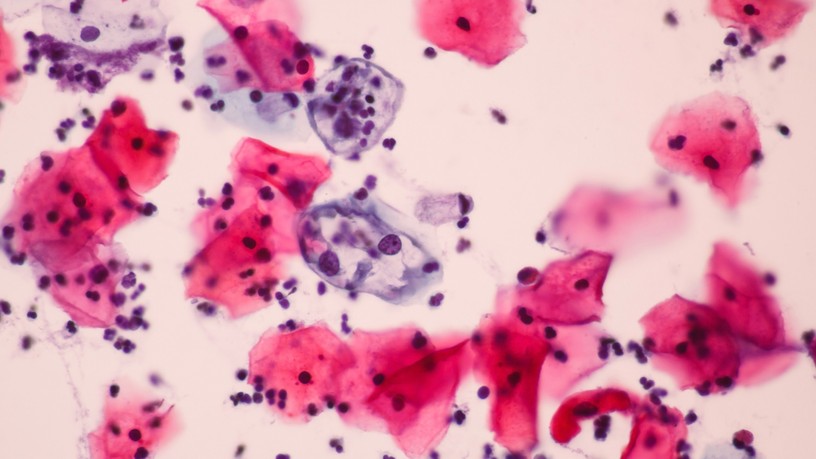 HPV vírus fertőzés hogyan lehet elkapni