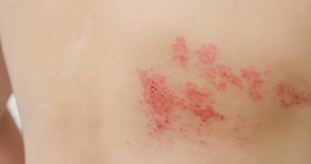 Övsömör: tünetei, vizsgálata és kezelési lehetőségei