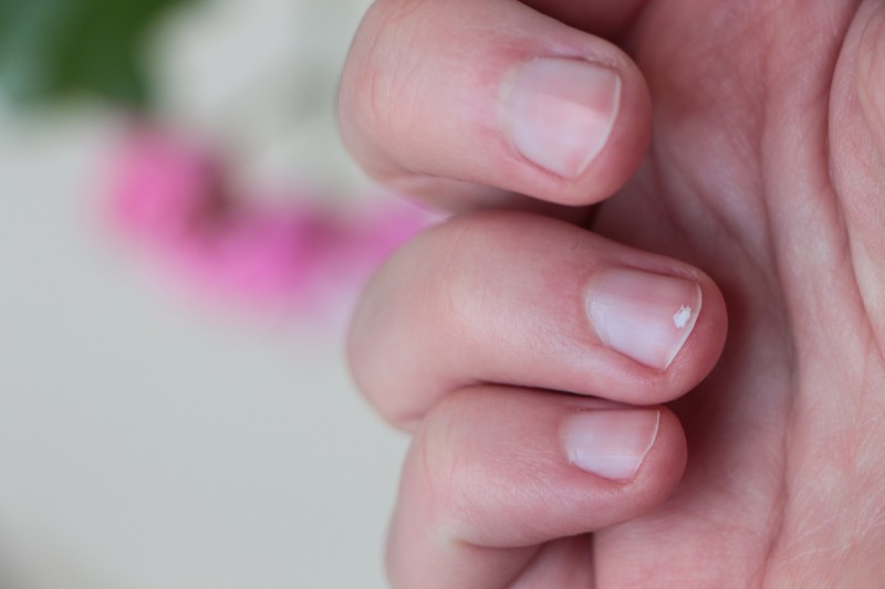 Fehérjehiány: milyen jelekből tudhatom, hogy nem eszek elég fehérjét?