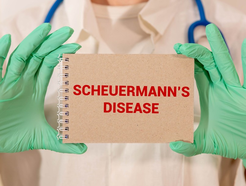 Scheuermann-kór tünet vizsgálat kezelés