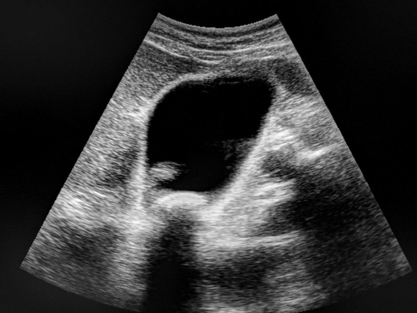 Epekövesség gyanúja esetén és általában minden hasfájással járó tünet esetében érdemes hasi ultrahangvizsgálatot végezni.