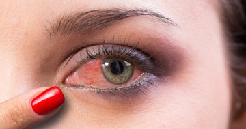  Viszket, éget, szúr a szeme? Ha kötőhártya-gyulladást kapott, nem mindegy, mivel borogatja 