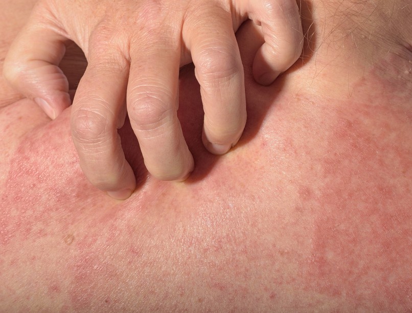 melegkiütés, allergia, napallergia tünet