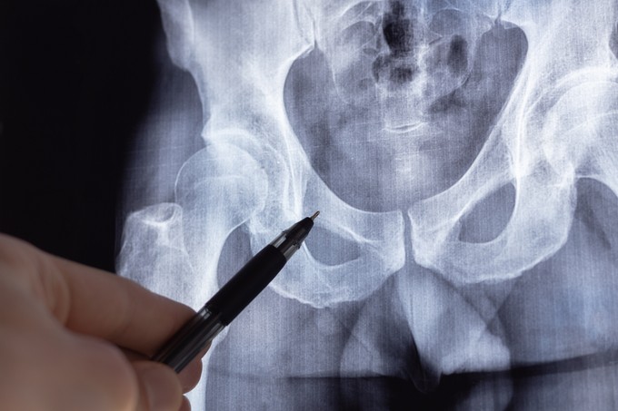 Mit tehetünk idősebb korban, hogy ne törjenek olyan könnyen a csontok? című cikk nyitóképe