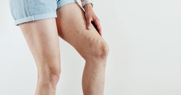  Sokaknak csak nyáron jut eszükbe a visszérműtét: ezt az eljárást ilyenkor is bevállalhatja 