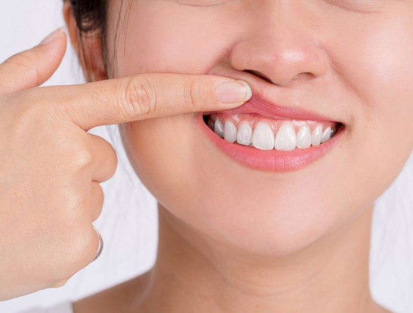 íny színe, fáradtság fejfájás vérszegénység tünete