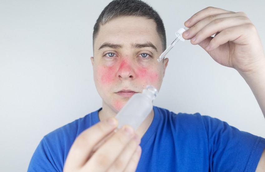 Gyakran ír fel a bőrgyógyász kéntartalmú lemosót vagy rázókeveréket. Igen fontos azonban tisztálkodáskor, hogy bőrünket ne szárítsuk ki nagyon, ne irritáljuk erős tisztítószerekkel.