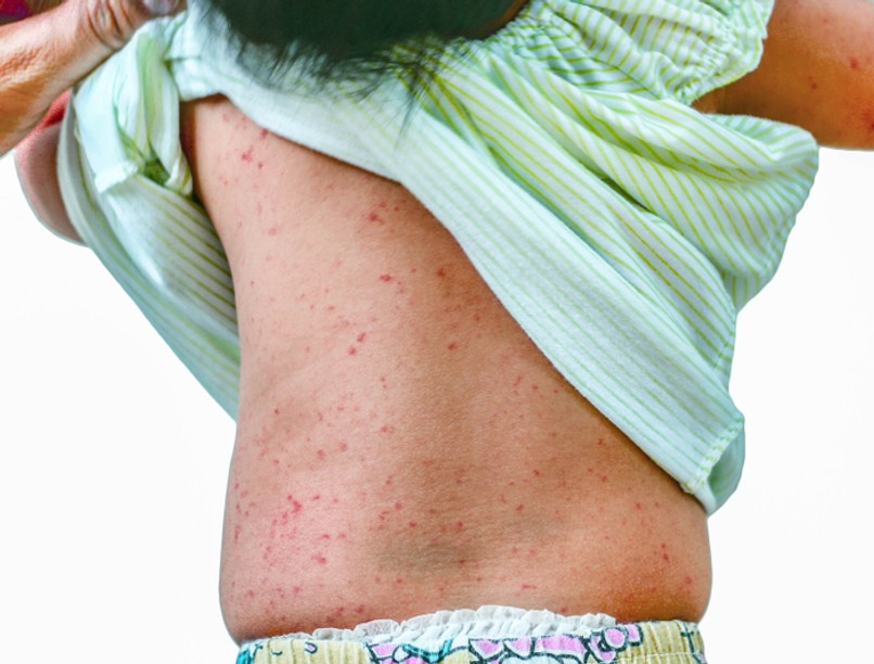 rózsahimlő, rózsahimlő kezelése