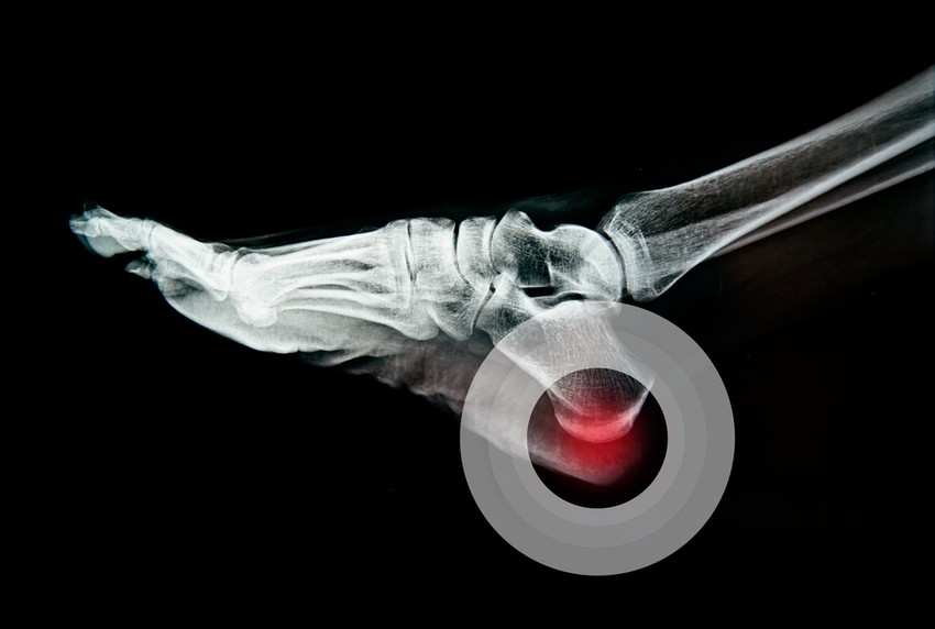 A plantar fasciitis (magyarul talpi bőnye gyulladás) egy, a talpon végighaladó szalad gyulladása, amely a saroktól a lábujjakig nyúlik. A fájdalom abból adódik, hogy ez a fascia (izomhüvely) irritálódik és begyullad.Mivel ez a fájdalmak leggyakoribb oka, ezért ezt az okok részletesebben kifejtjük, mint a későbbiekben a  többit.