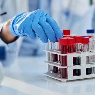 Egy új vérvizsgálat akár több mint 50 ráktípust képes lehet kimutatni - még a tünetek megjelenése előtt című cikk nyitóképe